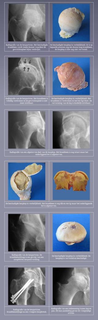 The affected hip joint