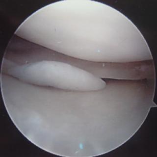 Flapscheur meniscus