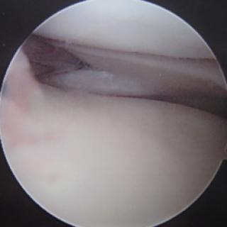 Gescheurde meniscus