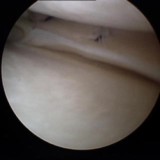 Klassieke sutuur meniscus